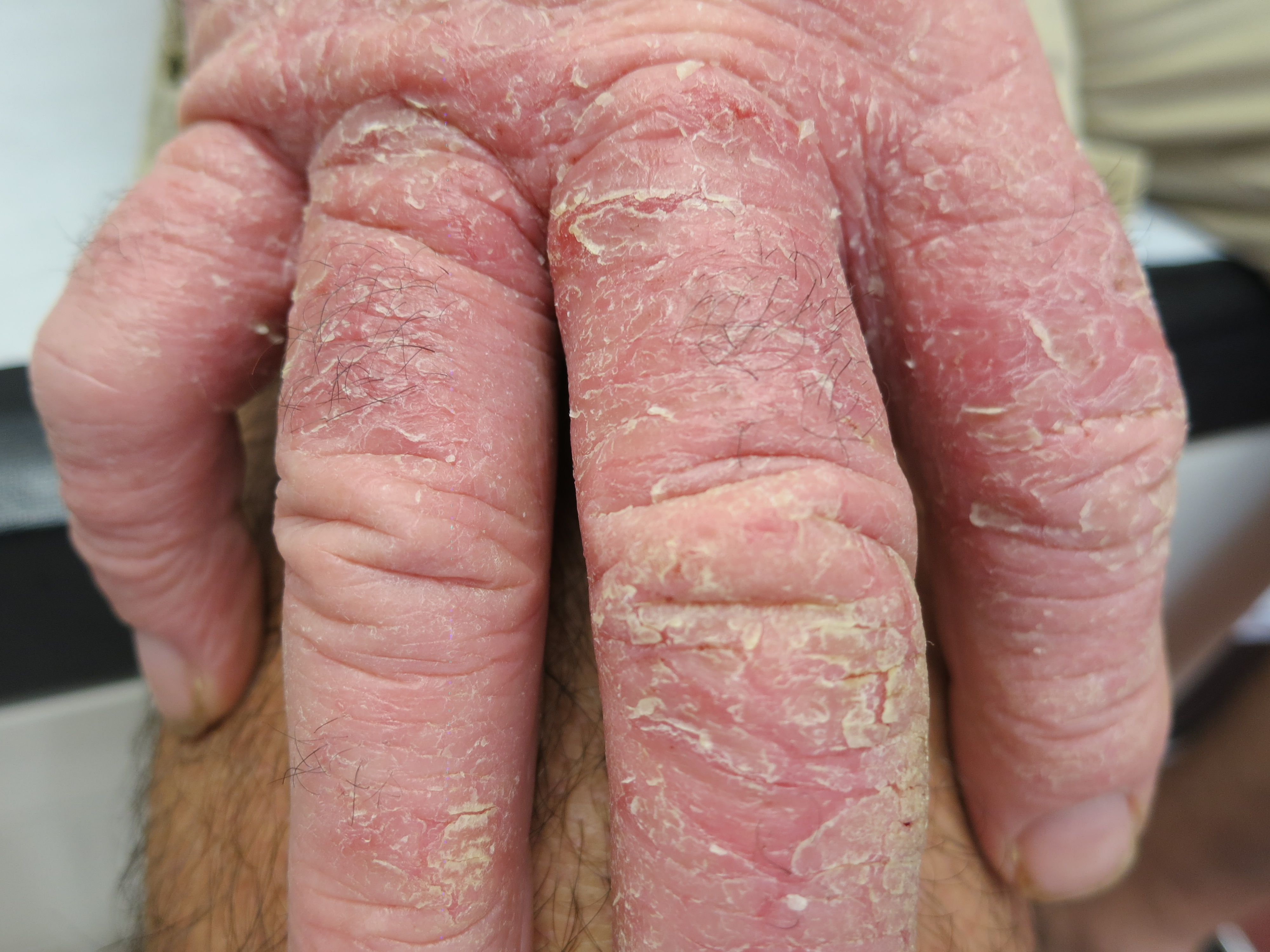 Le psoriasis vite les rappels