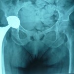Prothèse de hanche