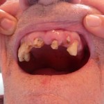 Dentition négligée