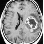 IRM d'une tumeur au cerveau